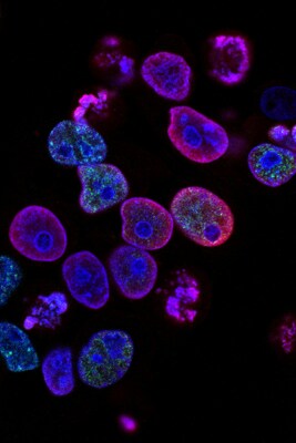 Close up of human cancer cells