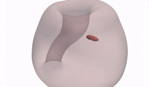 BYU prostate cancer.gif
