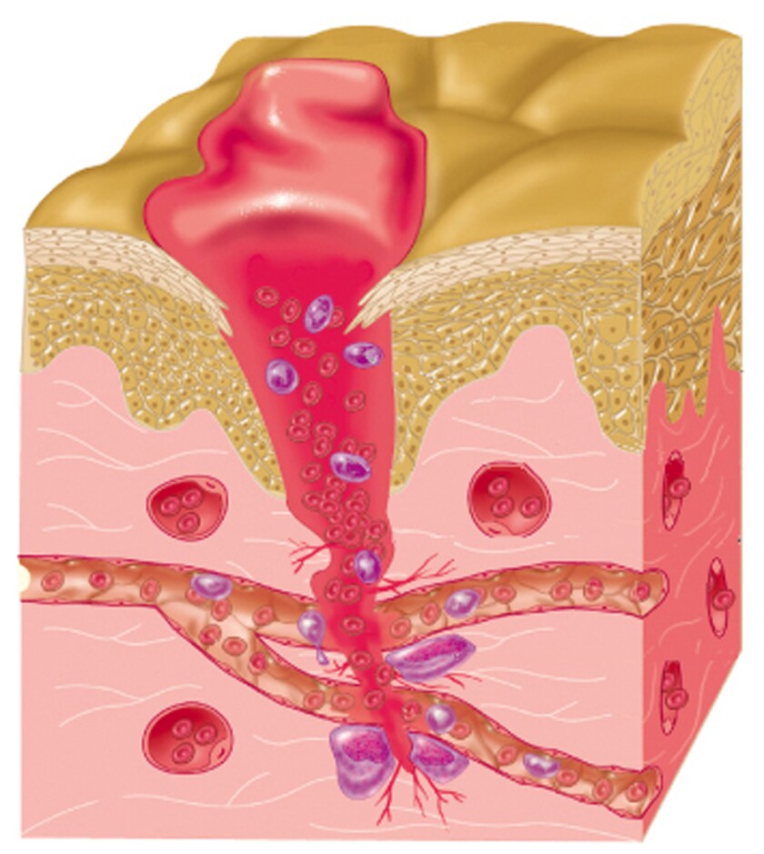 wound-h.jpg