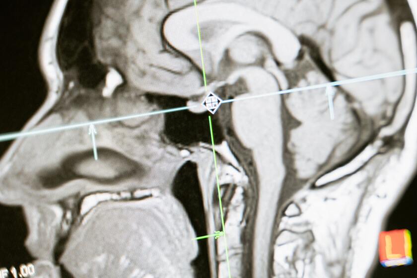 MRI image.jpeg